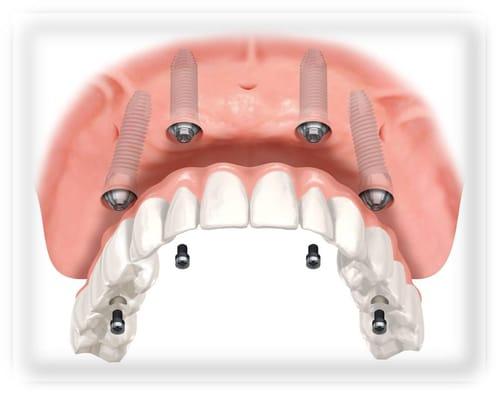 Fixed Implant retained Dentures