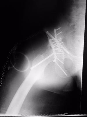 Right hip needed 14 screws and 3 pins