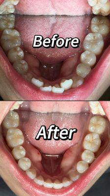 invisalign