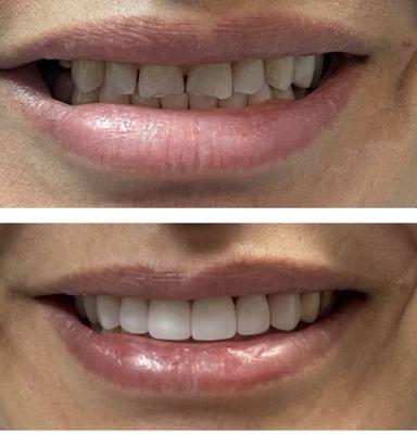 Patient disliked the shape, rotations, & chips on the edges of her upper front teeth.  She wanted rounded edges to make her smile youthful.