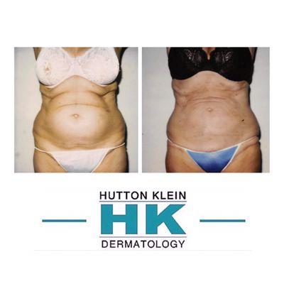 Tumescent Liposuction Before/After of the Abdomen by the creator of the Tumescent Technique, Jeffrey Klein, MD.