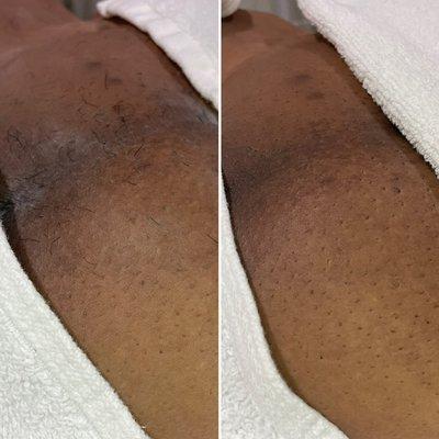 Before and after if a sugaring session