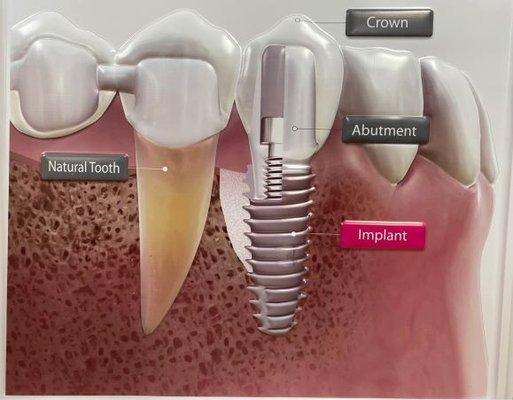 We are now offering an IMPLANT SPECIAL from MARCH-APRIL 2023. Your exact estimation may vary depending on your needs.
 Call at (909)822-4363