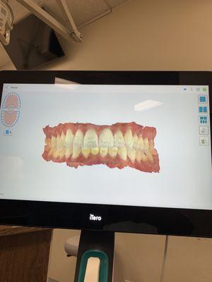 scan of my teeth gettinng straighter with invisalign!