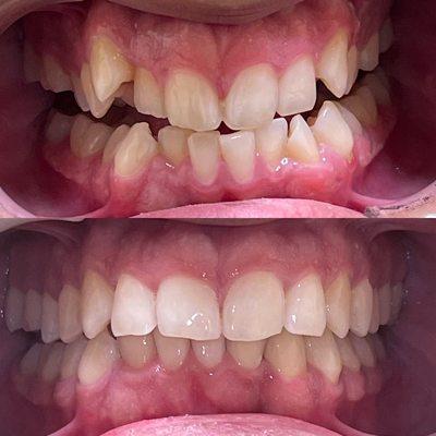 Invisalign Results