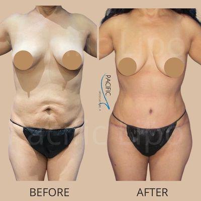 Tummy tuck