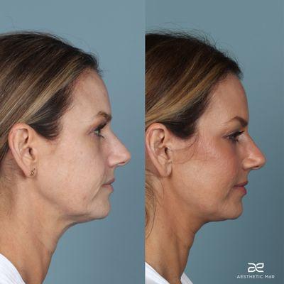 Deep plane face and neck lift, brow lift, with fat grafting to mid face. One year post-op!