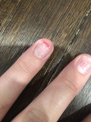 In this image you can see how much of my natural nail was ripped off and infected.