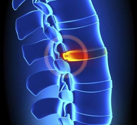 Omega's team of physical therapists and chiropractors can help you with disc related problems.