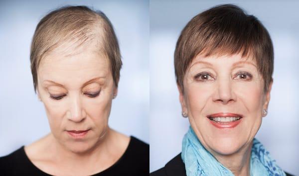 PK Salon offers the EVOLVE Volumizer as a solution to Hair Loss and Thinning Hair