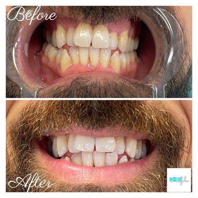 Before & After 1 hour teethes whitening