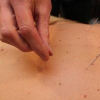 Acupuncture