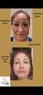 PDO Threads Non-Surgical face Lift