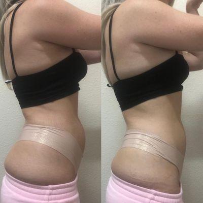 Before and after 1 session of - 40k cavitation  - Laser Lipolysis - RF Skin Tightening