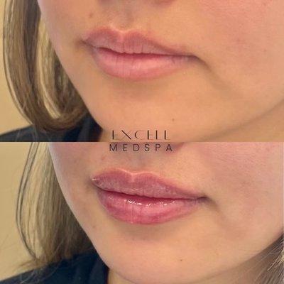 Before and after photos of our lip service treatment, showcasing the transformative results achieved by our skilled professionals.