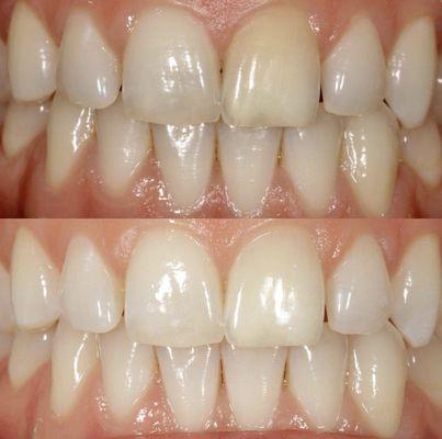 Single tooth internal bleaching of a dead tooth