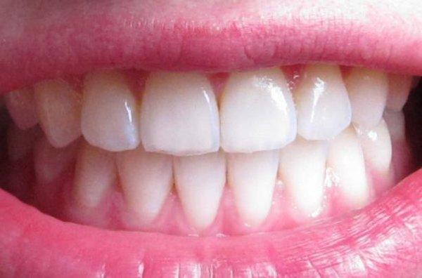 My beautiful teeth after braces