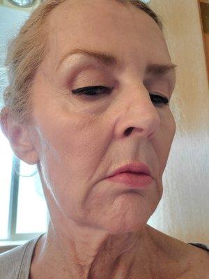 Protruding skin from too much filler.