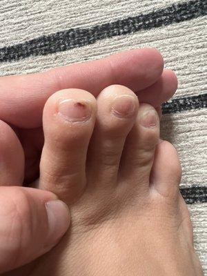 Damaged nails during pedicure