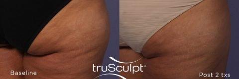 Best Body Sculpting and Cellulite Reduction Montebello, CA