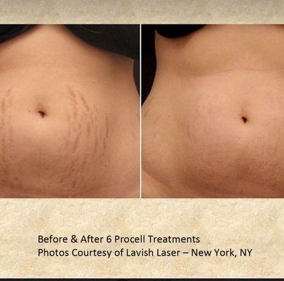 Collagen induction therapy and stem cell treatment reduce stretch marks