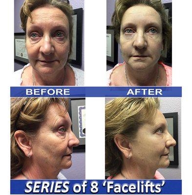 Before/After 8 Facelifts