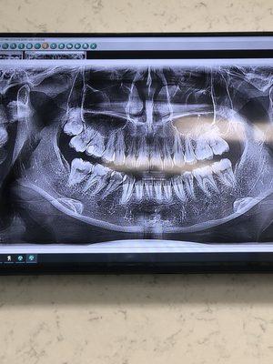 Wisdom tooth