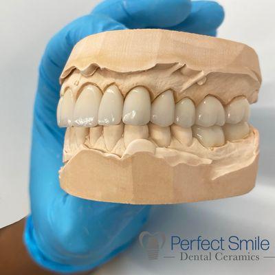 Emax veneers and crowns