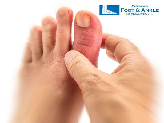 Big toe pain treatment