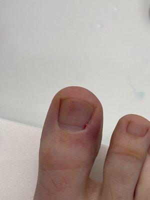 Infected toe after pedicure