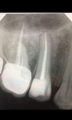 After X-ray tooth #4, Root canal completed with build-up, crown will be done next visit.