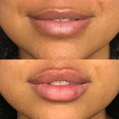 Before and after lip fillers