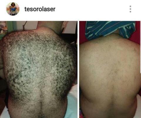 Laser hair removal