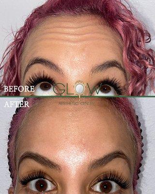 Dysport before and after Glow Aesthetic Center