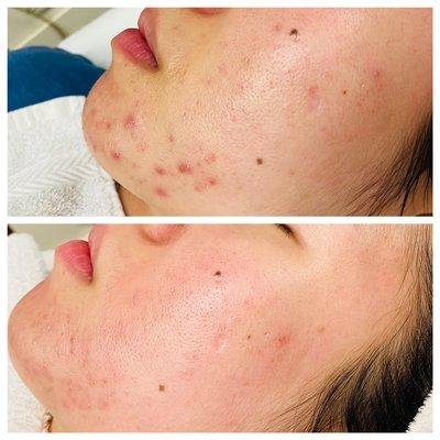 Before and After pictures of cystic acne