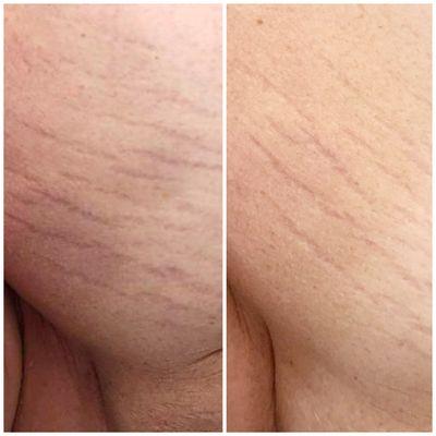 Results for stretchmarks after two Microneedling treatments