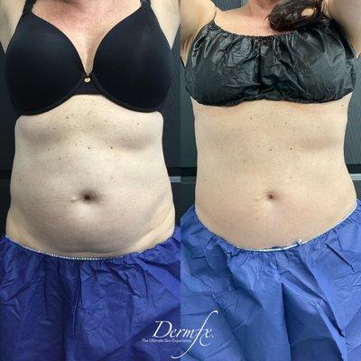 Coolsculpting