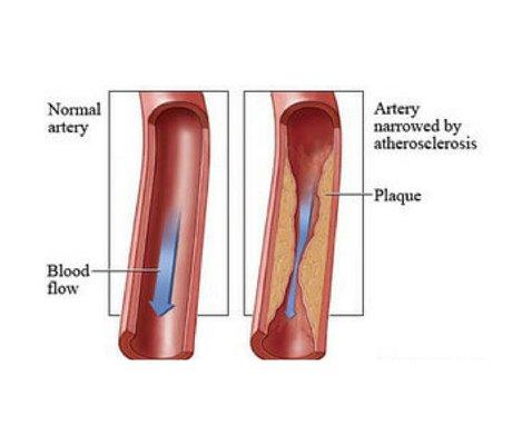 PAD Infographic - Stent Angio