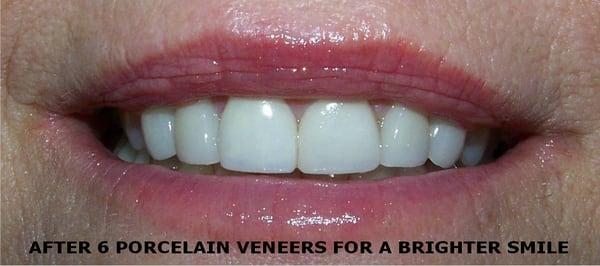 After Porcelain Veneers to cover dark, worn teeth.