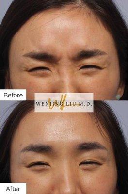 Botox treatment