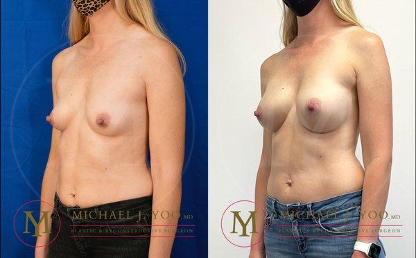 Breast Augmentation by Dr. Michael J. Yoo, MD - Double Board Certified Plastic Surgeon