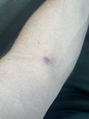 Bruised / raised injection site