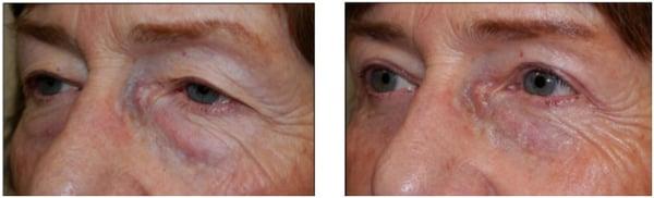 upper and lower eyelid blepharoplasty