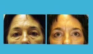 Before and after six sessions of Beauty Tek 
By Dr. Meschi