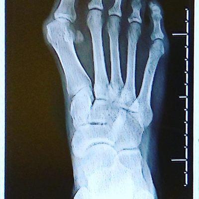 Right bunion and long toe before surgery