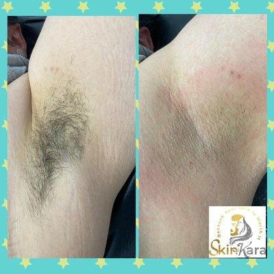 Underarm waxing is a quick and easy way to stay hair free for 4-6 weeks!