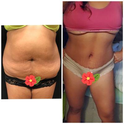 Tummy Tuck 3 weeks post op