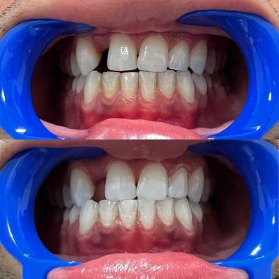 Before & After a 60 mins teeth whitening procedure