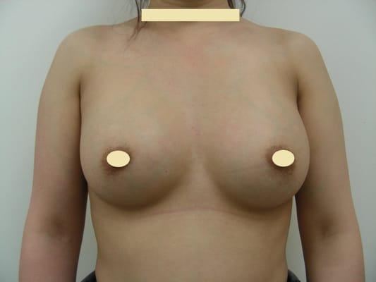 3 months after breast augmentation.