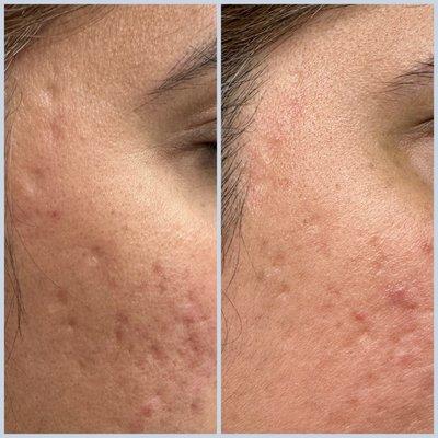 Acne scarring treatment!